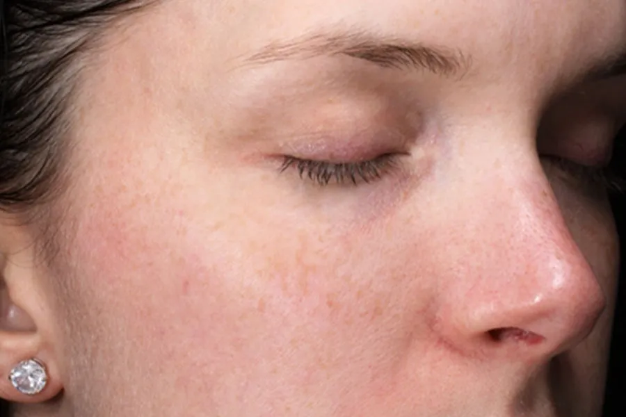 Microneedling