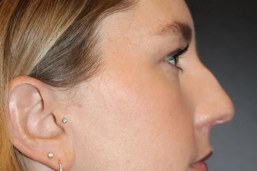 Nickels, D, Cosmo, After, Kybella 001.jpg
