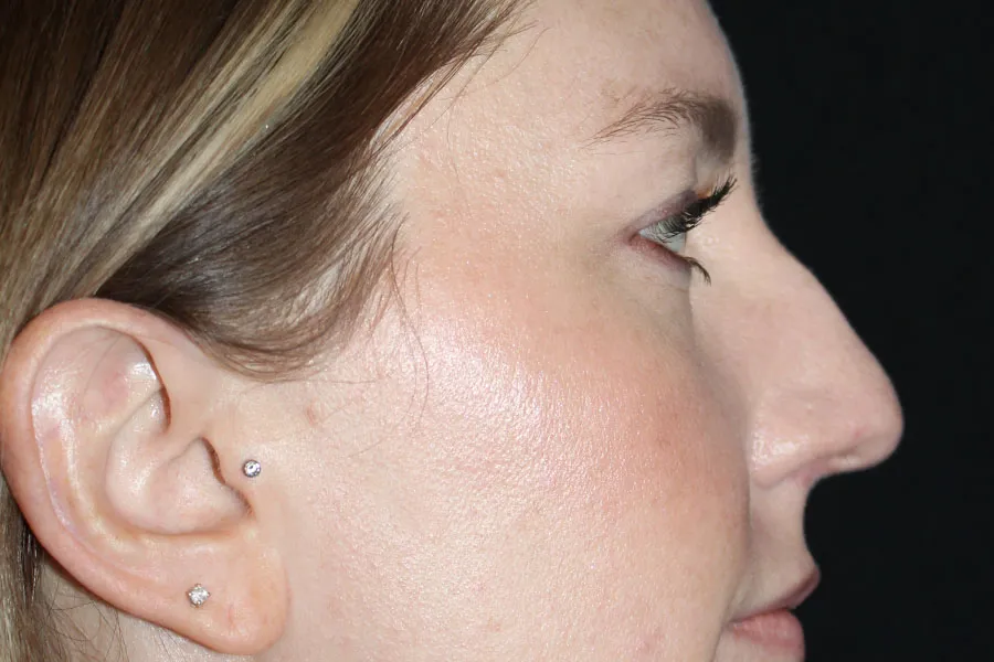 Kybella