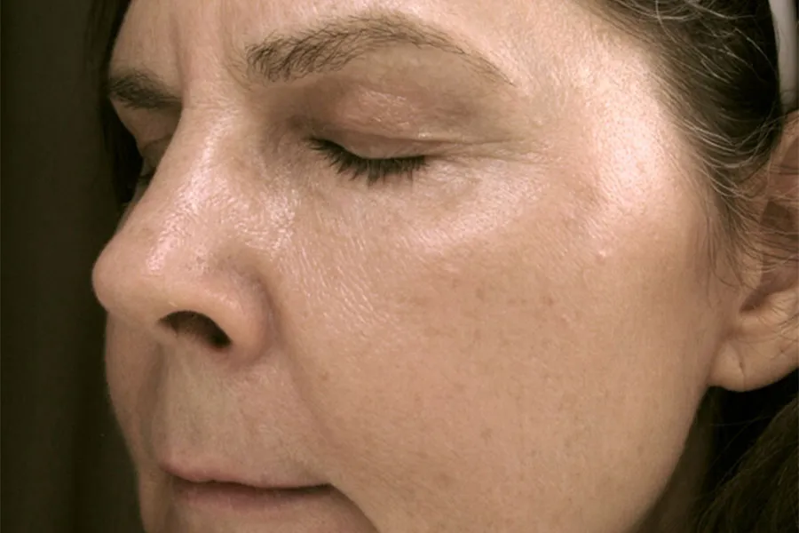 Northstar Peel: Forever Young Phototherapy, Microlaser Peel, & Profractional Laser