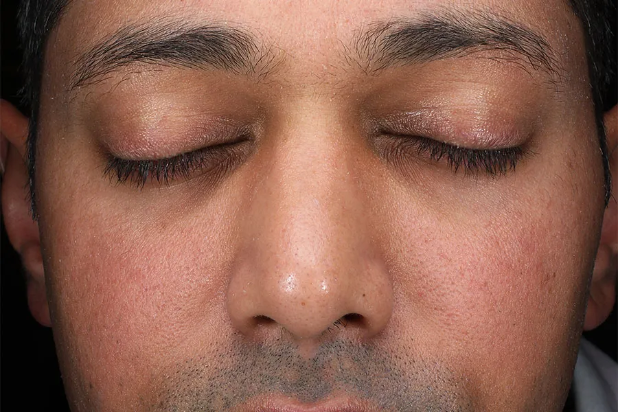 Microneedling