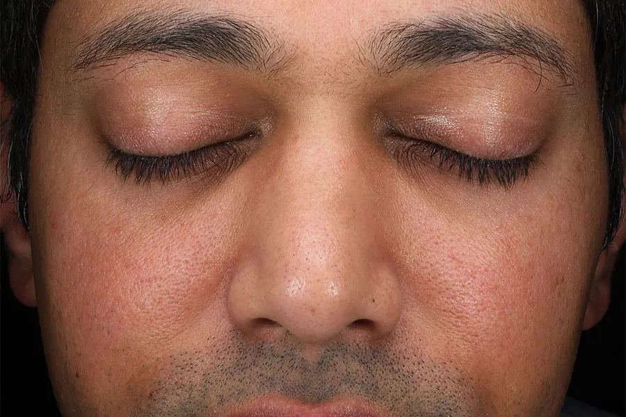 Patel, P Cosmetic 1 week After tx Microneedling 001/Patel, P Cosmetic beforeMicroneedling 001