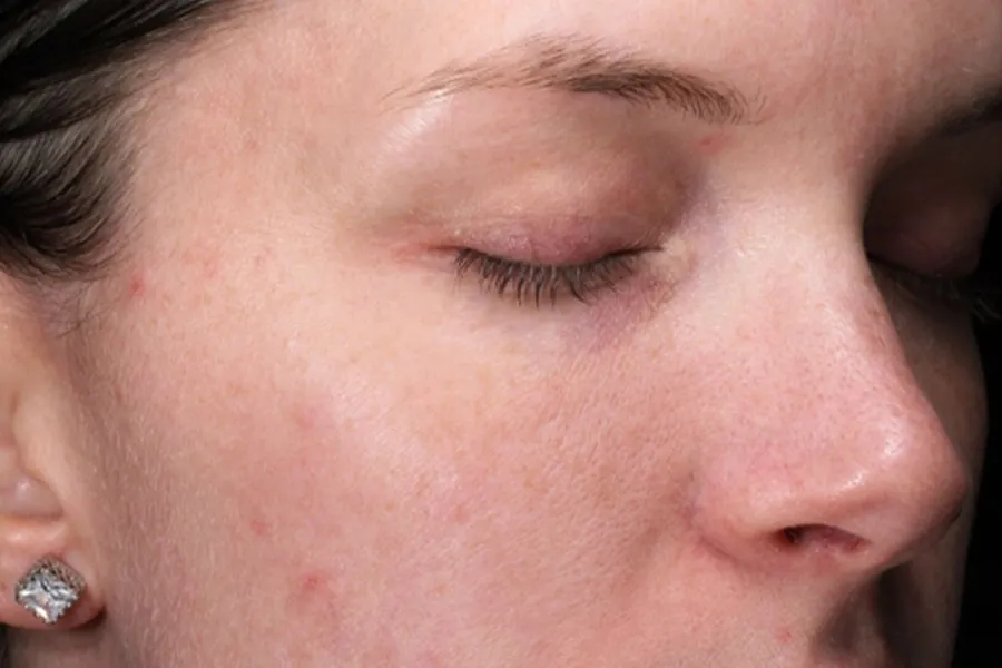 Microneedling before / microneedling after