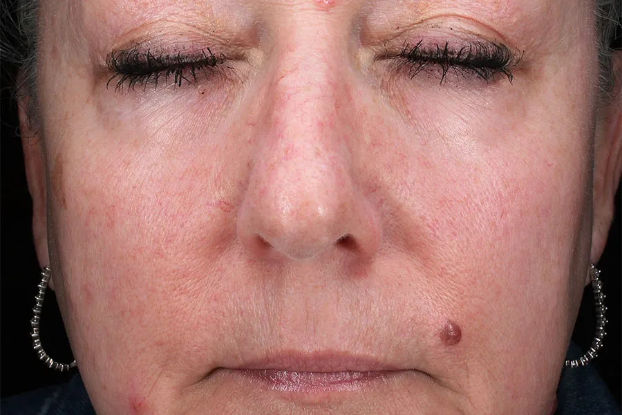 Cheeks Filler