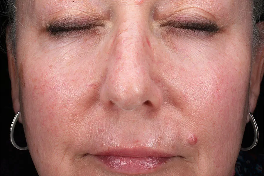 Cheeks Filler