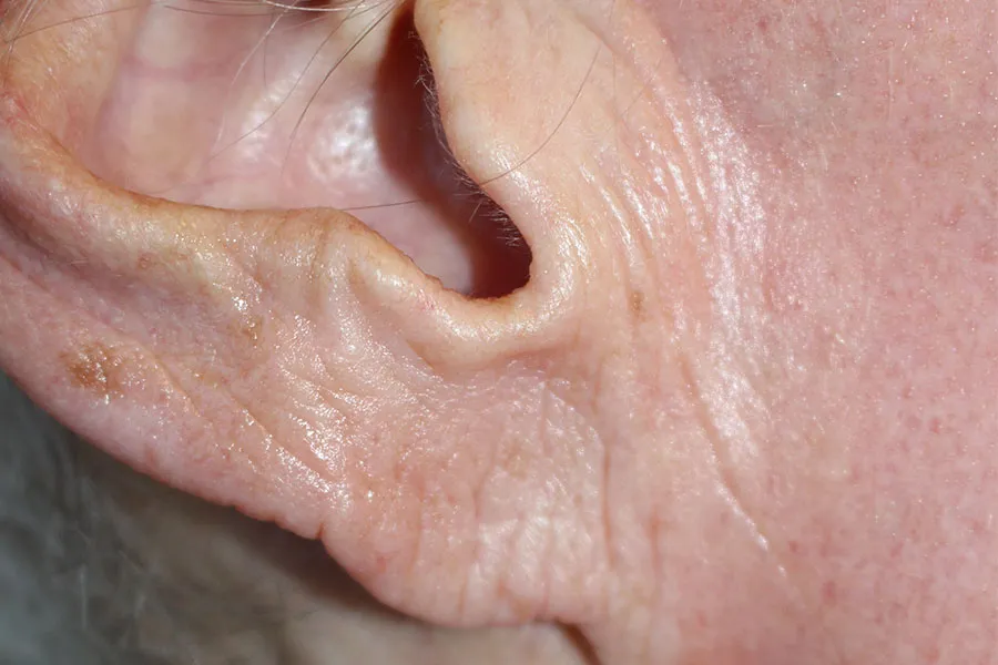 Earlobe