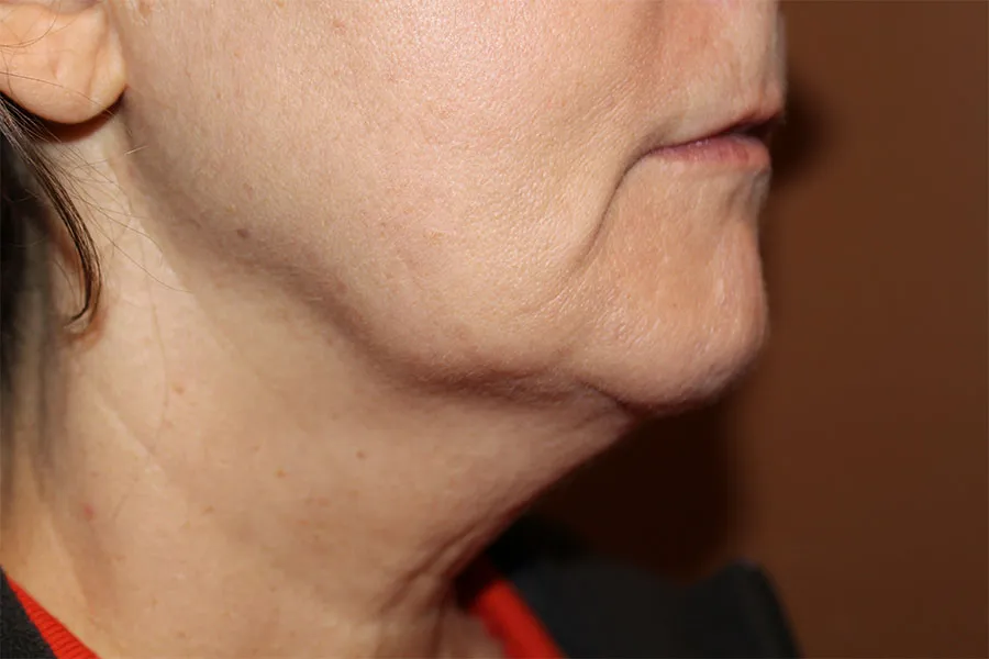 Kybella
