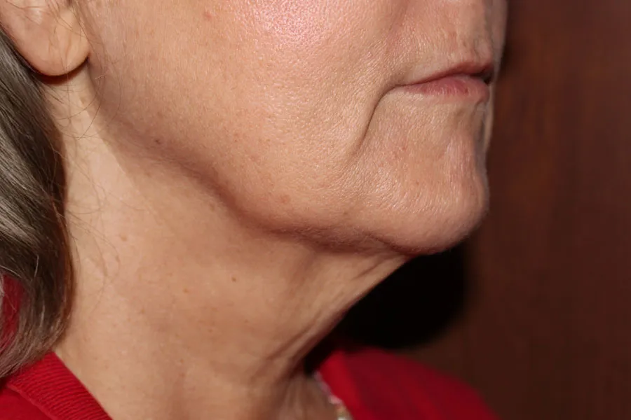 Kybella