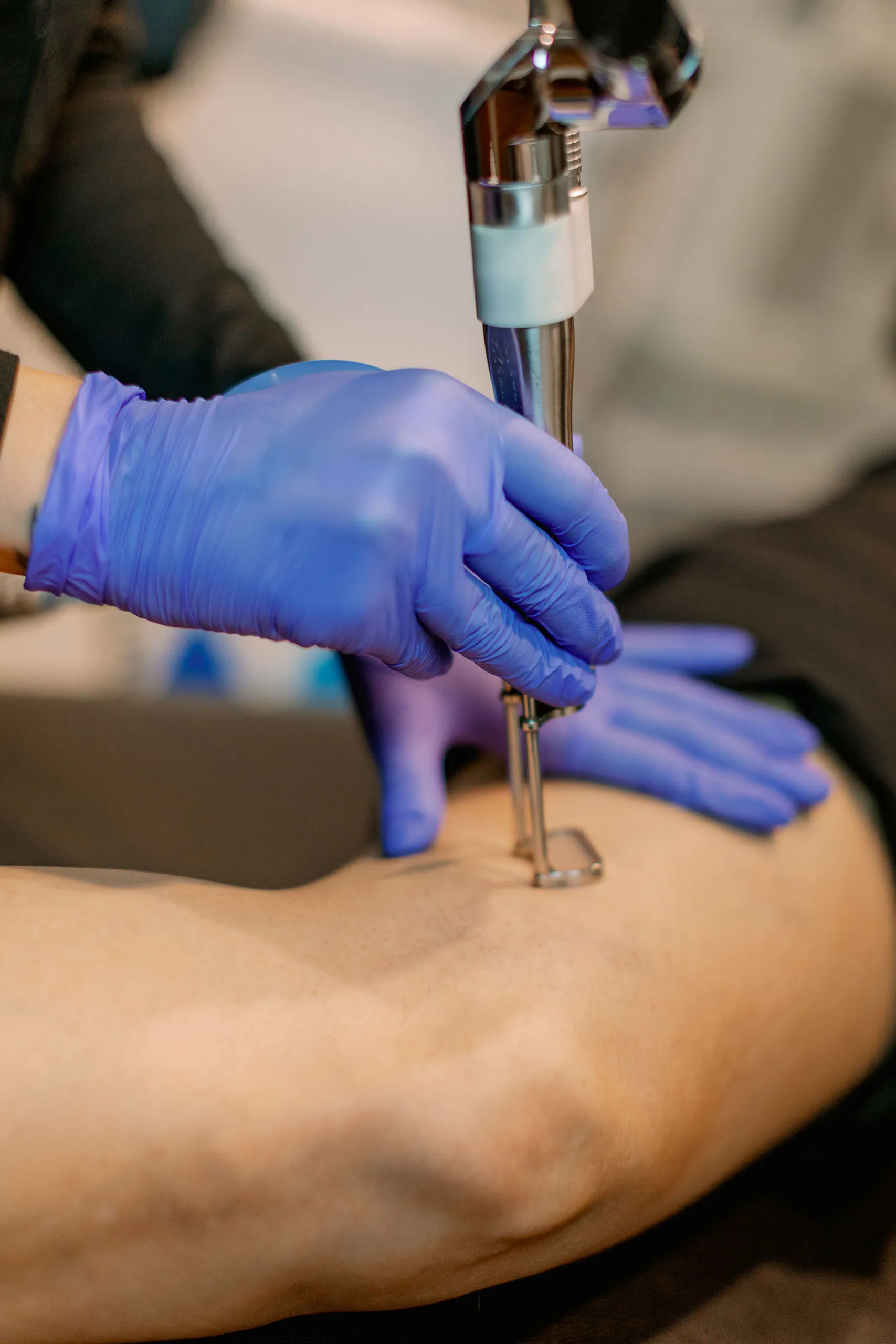 Spider Vein Treatment