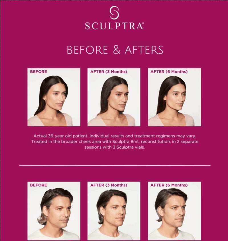 Sculptra before & afters