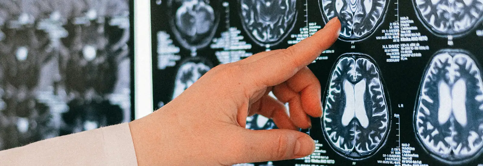 Dr.Yashar reviewing MRI for neurosurgery spine and brain surgery in Los Angeles CA