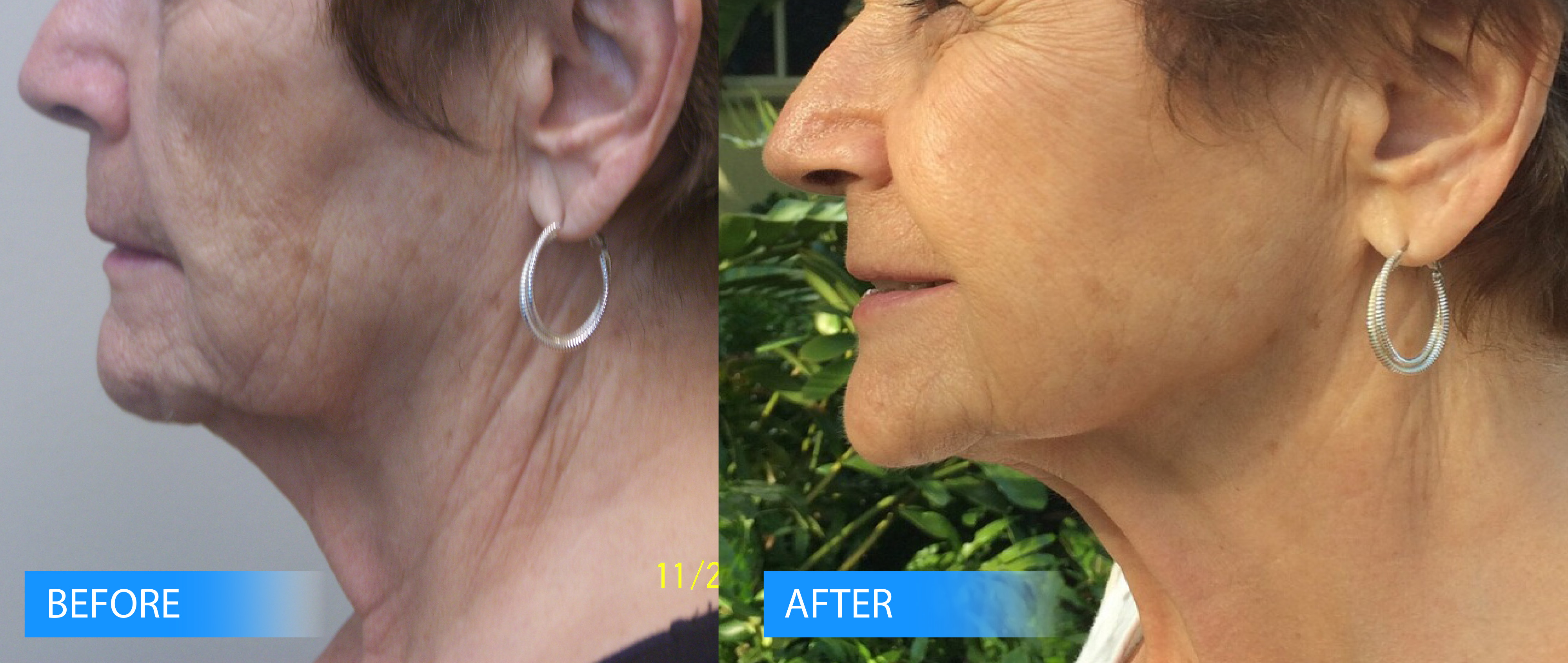 Thermitignt before and after patient neck