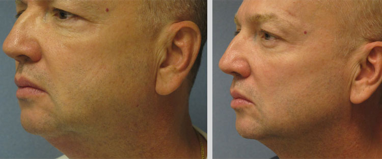 Thermitight before and after patient male