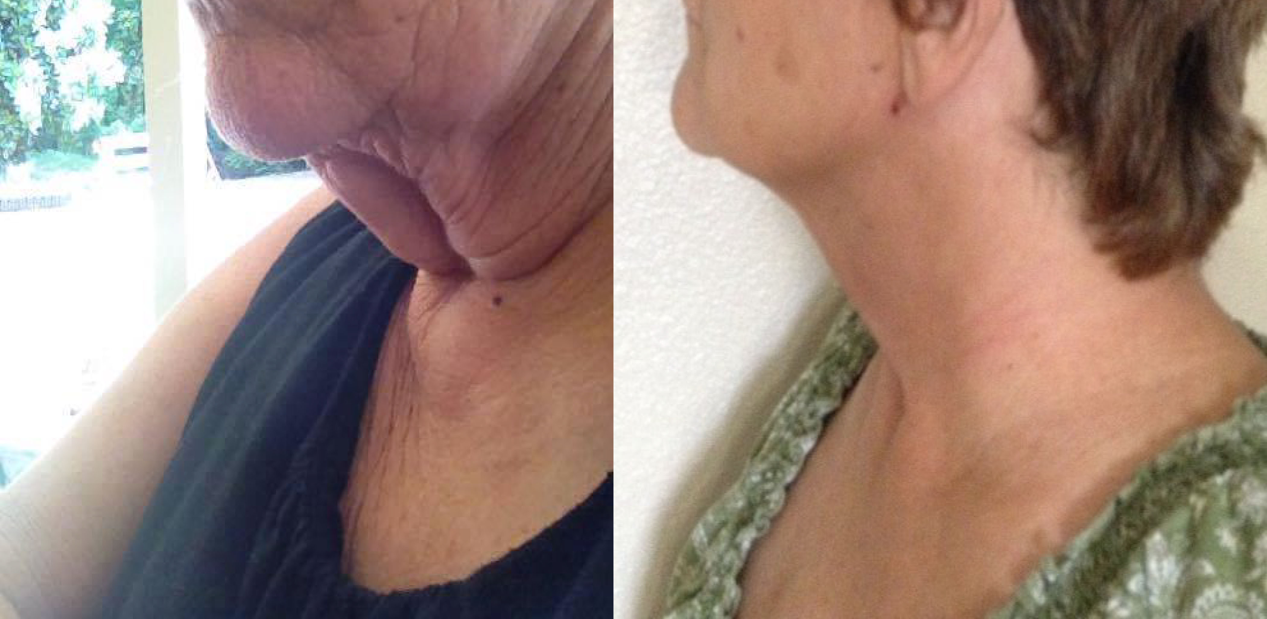 ThermiTight Female Patient Before and After 