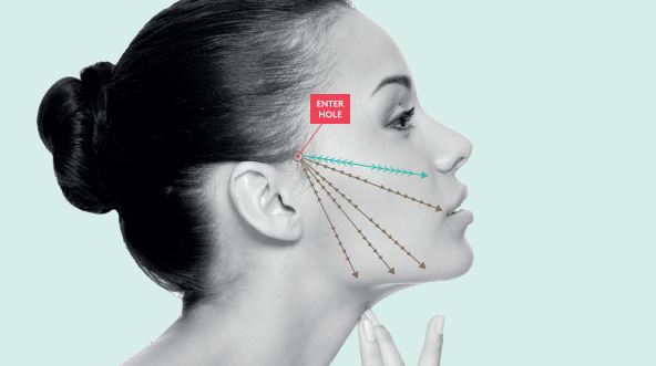 Cheek Lifting Thread 