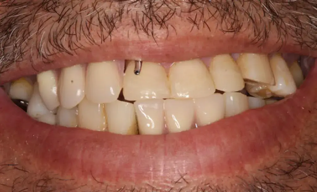 A close-up of a person's smile showing one visible tooth piercing on the upper teeth.