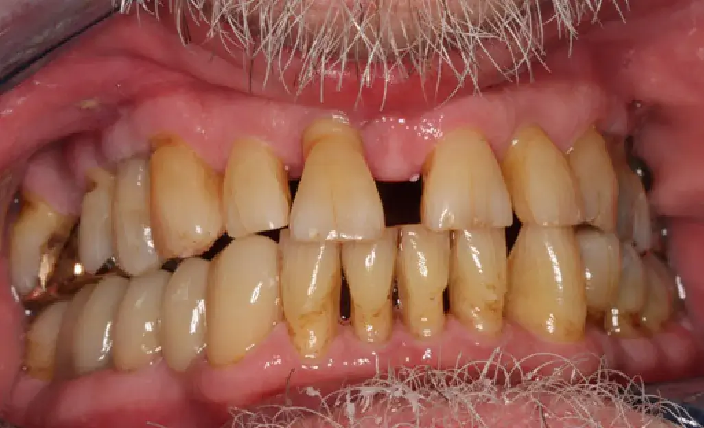 Close-up of a person's mouth showing discolored teeth and gums with visible plaque buildup.