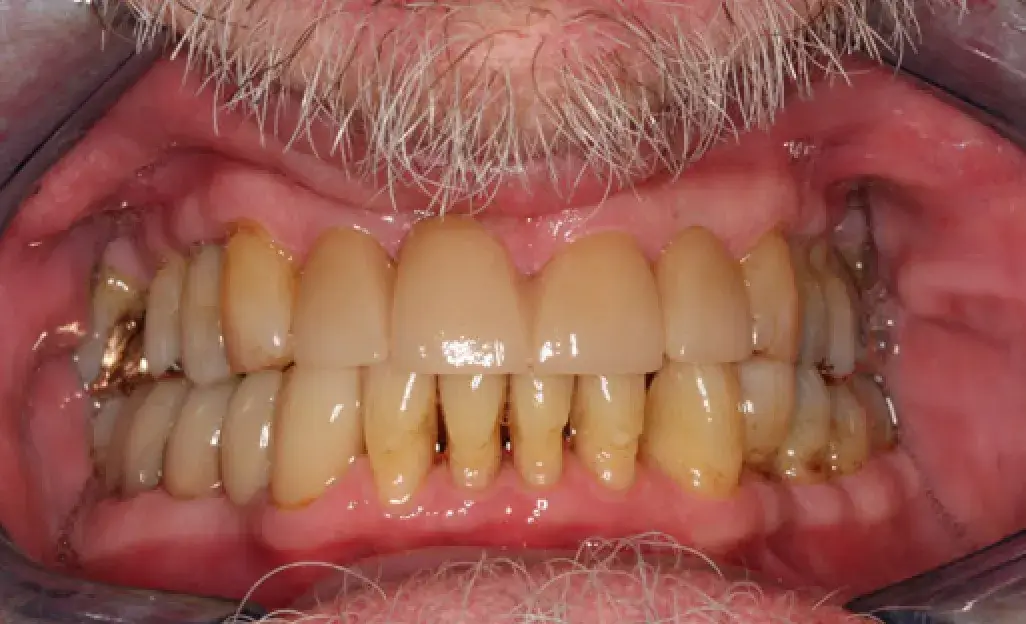 A close-up of a person's mouth showing stained and uneven teeth with visible gums.