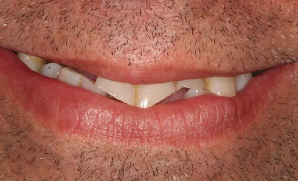 A close-up of a person’s mouth with slightly yellowed teeth and stubble above the upper lip.