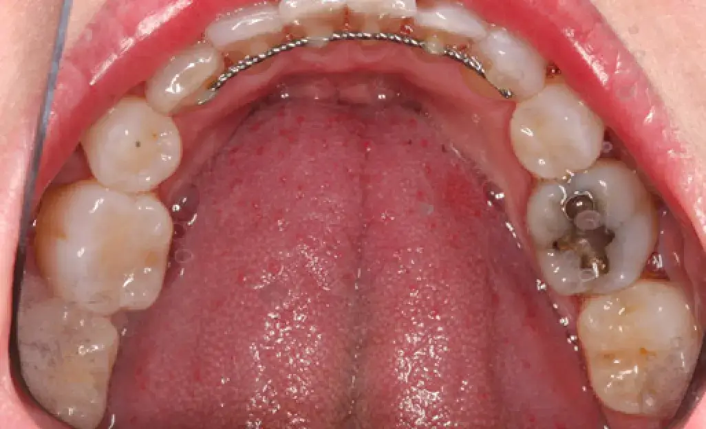 Close-up of an open mouth showing dental cavities on the upper molars.
