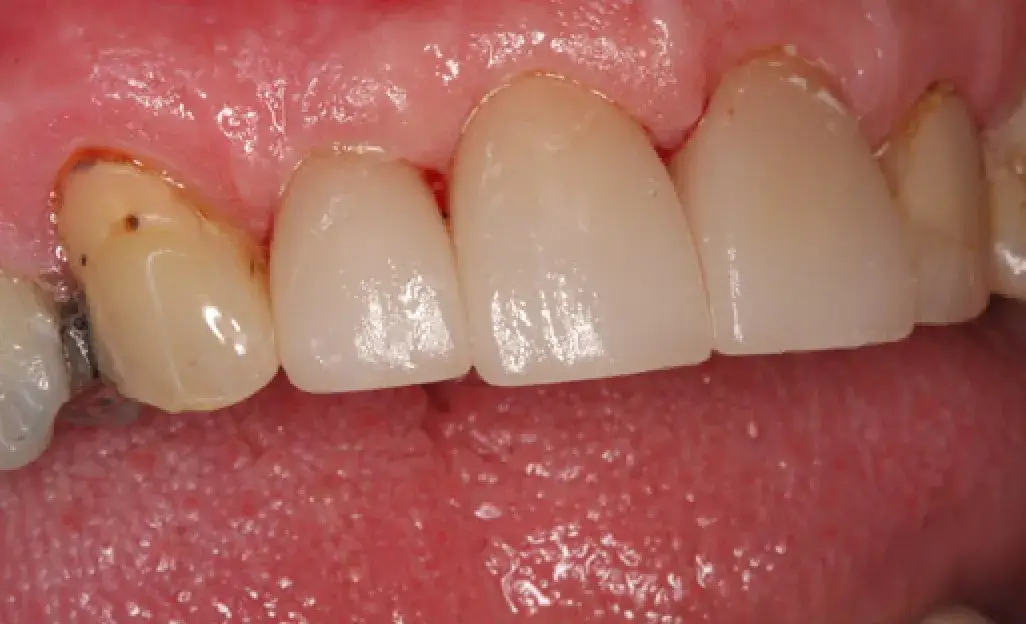 Close-up of upper front teeth with one tooth showing decay.