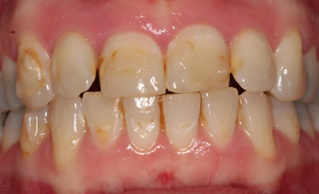 Close-up of discolored upper teeth showing plaque buildup and gingivitis on gums.