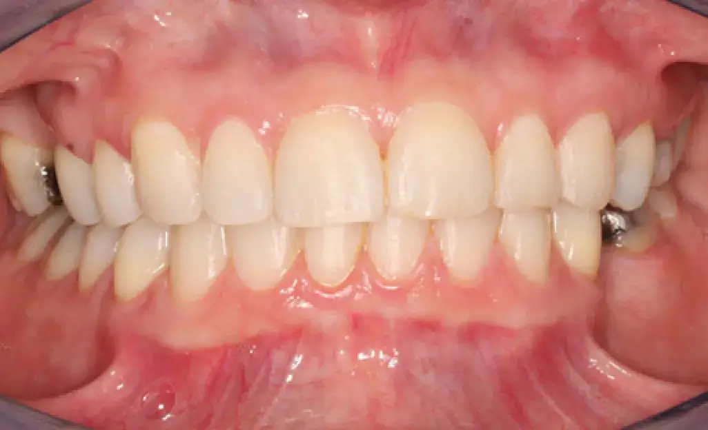 A close-up of human teeth with gums visible.