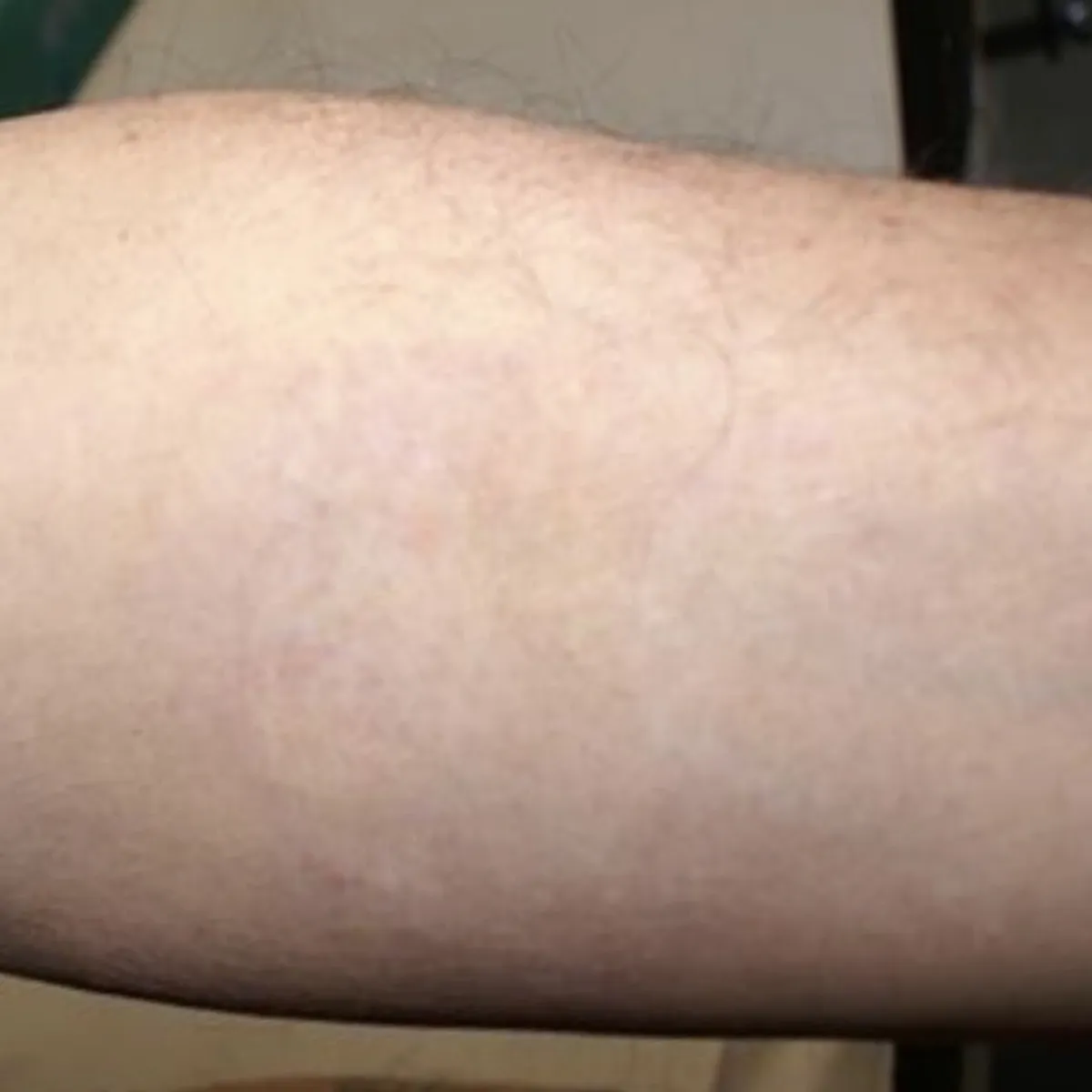 Close-up of a forearm with faint, healed skin discoloration or scar.