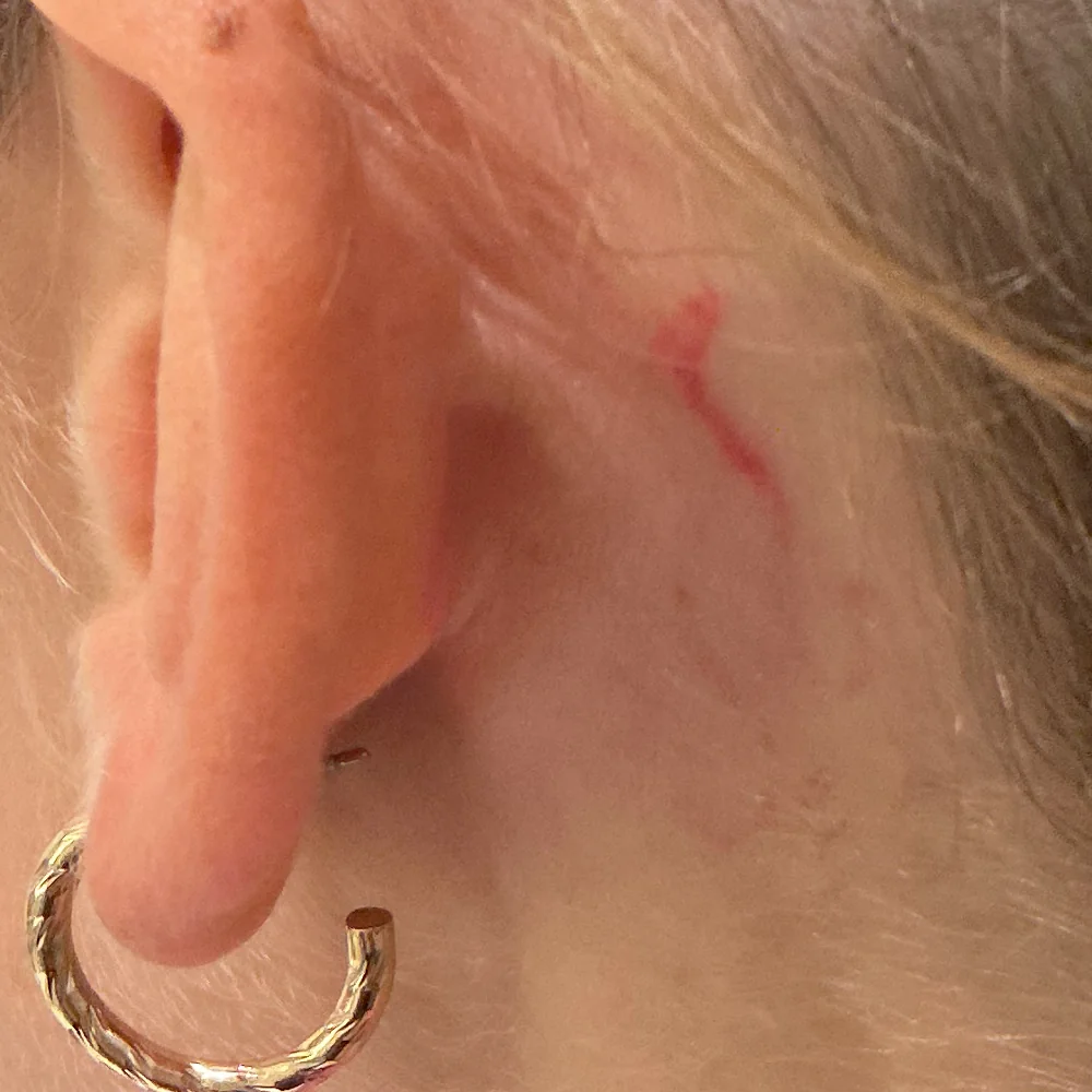 Même zone derrière l'oreille après une séance de laser Discovery Pico, encre rouge en grande partie effacée