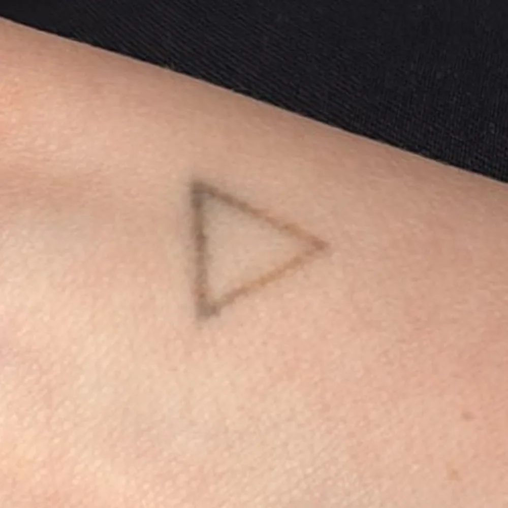 Même tatouage triangle au poignet après une séance de laser Discovery Pico, nettement éclairci