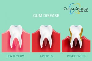 Bleeding Gums