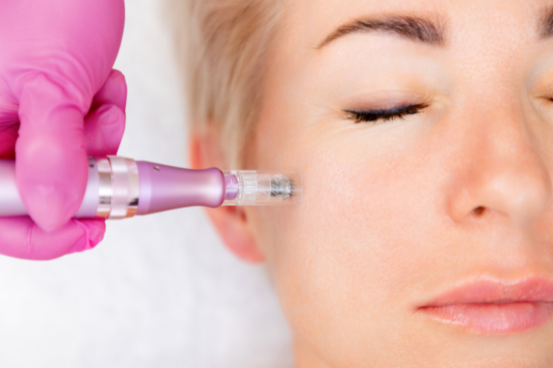 🌸 Facial Micro-Needling: Your Path to Radiant, Renewed Skin