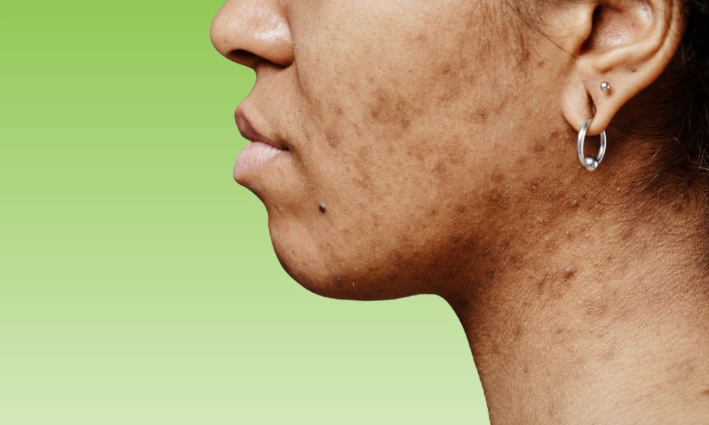 Acne Scars
