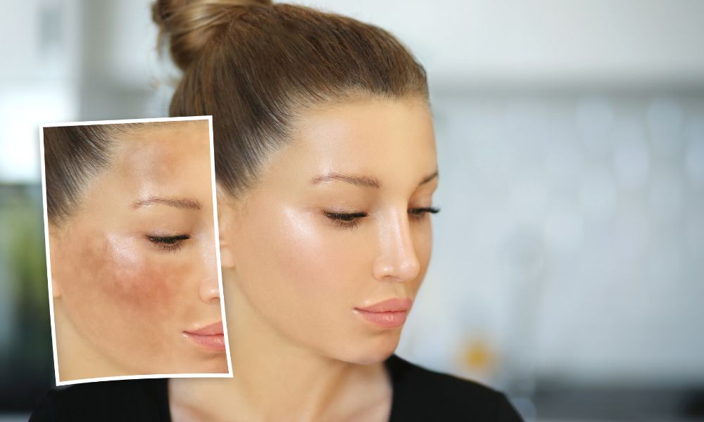 Sun Damage
