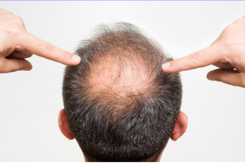 Holistic Solutions for Male Pattern Baldness: What Really Works?