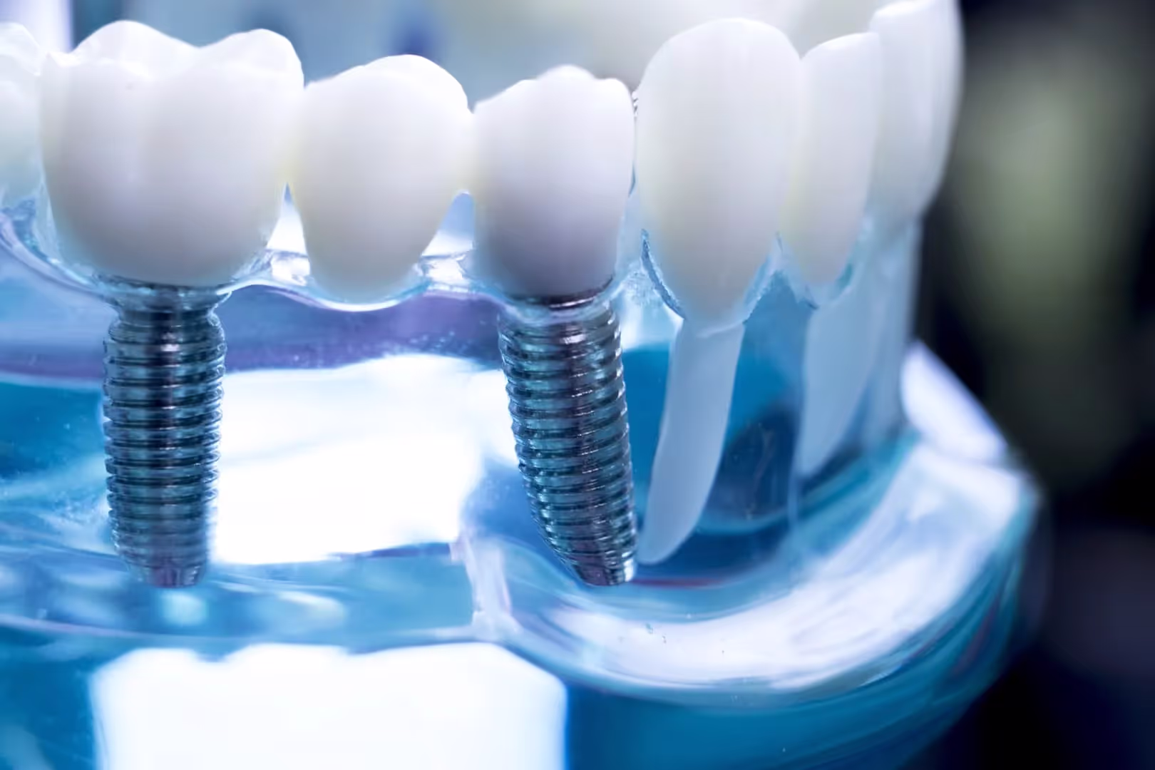 Do All on 4 Implants Take a Long Time To Heal?