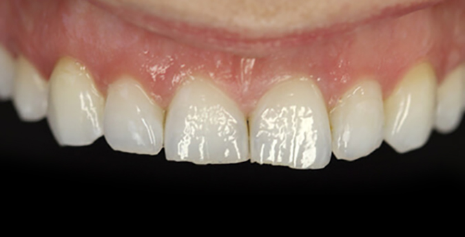 Composite-1