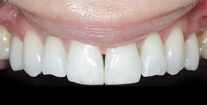 Composite-2