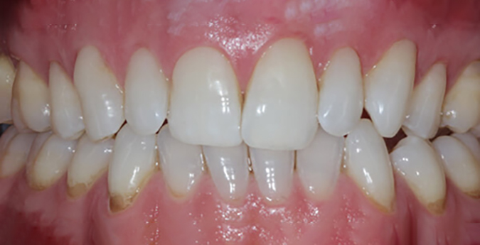 Composite-3