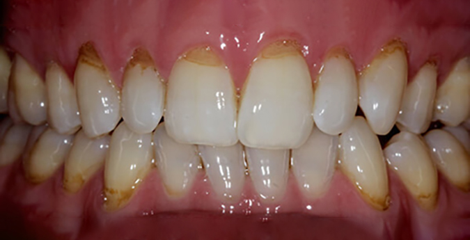 Composite-3