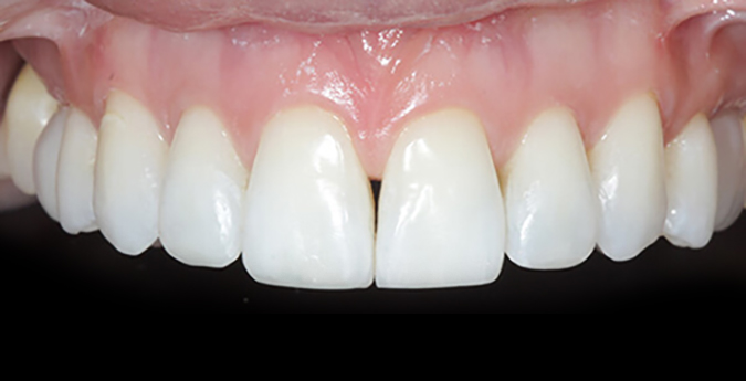 Composite-2