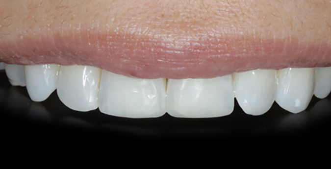 Composite-4