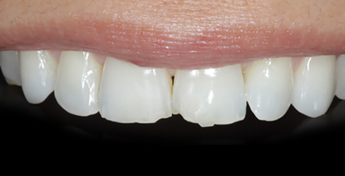 Composite-4