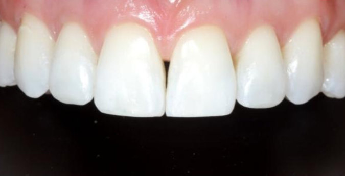 Composite-5