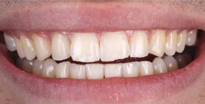 Composite-6