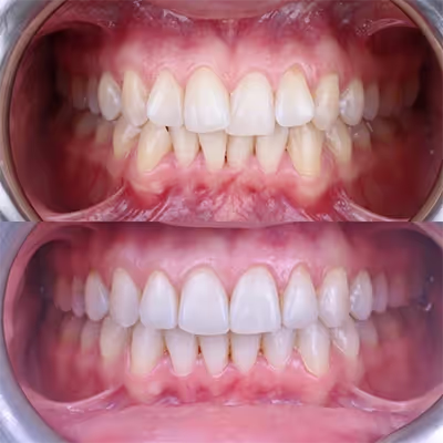 Invisalign teeth whitening composte bonding 1