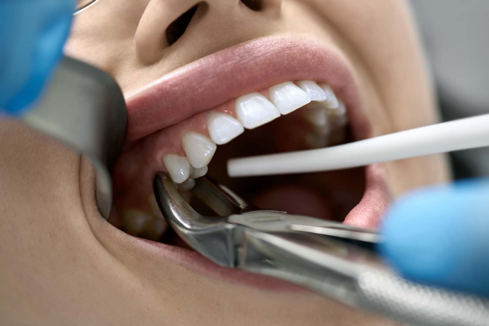 Tooth Extractions 