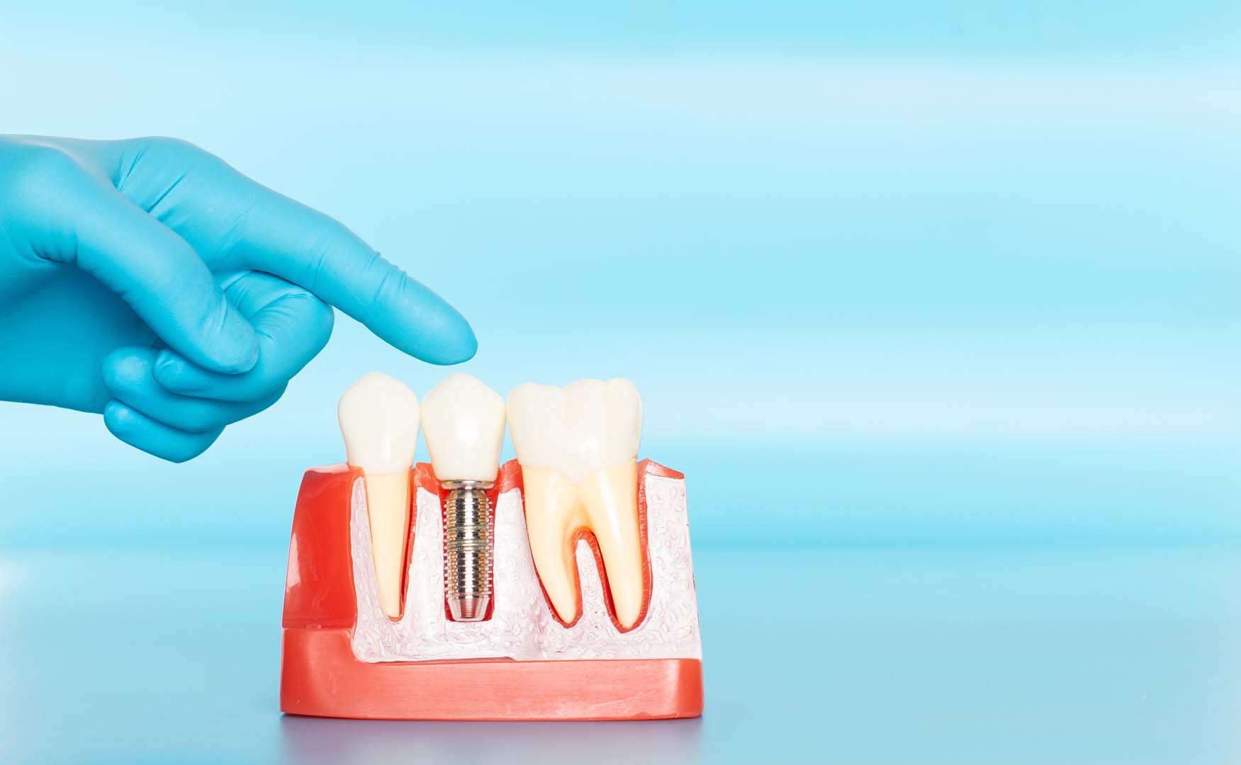 Dental Implants