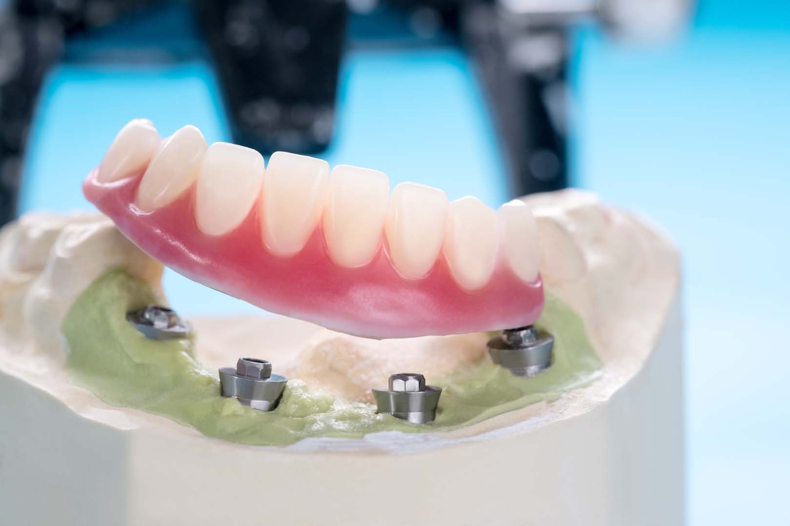 Implant Supported Dentures 