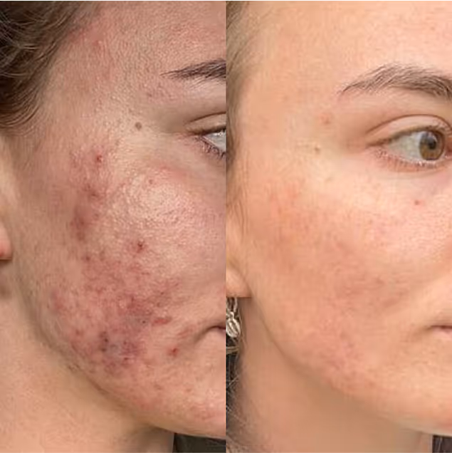 Image showing before and after results of facial skincare treatments at Natural Beauty by Helen, Twickenham clinic.